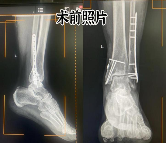 石拐区医院成功完成一例左踝关节骨折内固定取出术（蒙）.jpg